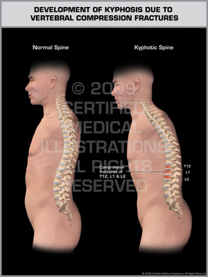 Exhibit of Development of Kyphosis Due to Vertebral Compression Fractures Male. Exhibit of Development of Kyphosis Due to Vertebral Compression Fractures Male.