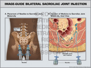Exhibit of Image-Guide Bilateral Sacroiliac Joint Injection. Exhibit of Image-Guide Bilateral Sacroiliac Joint Injection.