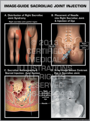 Exhibit of Image-Guide Sacroiliac Joint Injection. Exhibit of Image-Guide Sacroiliac Joint Injection.