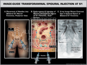 Exhibit of Image-Guide Transforaminal Epidural Injection at S1. Exhibit of Image-Guide Transforaminal Epidural Injection at S1.