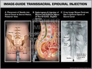 Exhibit of Image-Guide Transsacral Epidural Injection. Exhibit of Image-Guide Transsacral Epidural Injection.