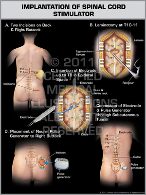 Exhibit of Implantation of Spinal Cord Stimulator Male.