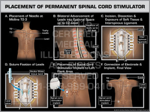 Exhibit of Placement of Permanent Spinal Cord Stimulator Female. Exhibit of Placement of Permanent Spinal Cord Stimulator Female.