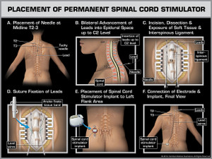 Exhibit of Placement of Permanent Spinal Cord Stimulator.