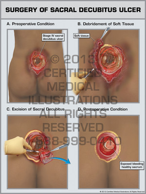 Exhibit of Surgery of Sacral Decubitus Ulcer. Exhibit of Surgery of Sacral Decubitus Ulcer.