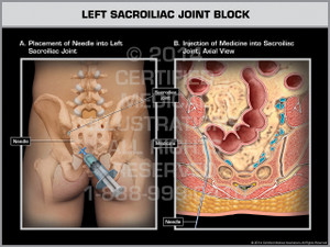 Exhibit of Left Sacroiliac Joint Block. Exhibit of Left Sacroiliac Joint Block.