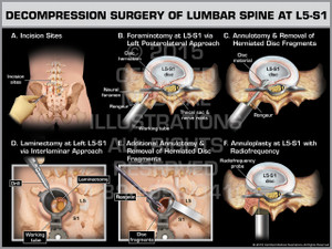 Exhibit of Decompression Surgery of Lumbar Spine at L5-S1.