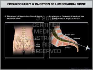 Exhibit of Epidurography & Injection of Lumbosacral Spine. Exhibit of Epidurography & Injection of Lumbosacral Spine.