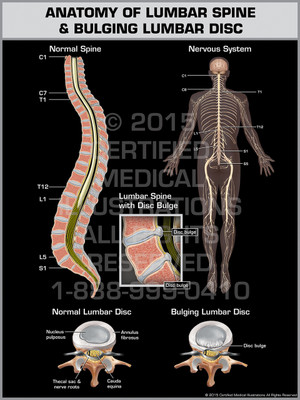 Exhibit of Anatomy of Lumbar Spine & Bulging Lumbar Disc. Exhibit of Anatomy of Lumbar Spine & Bulging Lumbar Disc.
