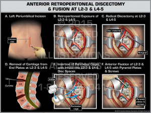 Exhibit of Anterior Retroperitoneal Discectomy & Fusion at L2-3 & L4-5. Exhibit of Anterior Retroperitoneal Discectomy & Fusion at L2-3 & L4-5.