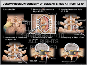 Exhibit of Decompression Surgery of Lumbar Spine at Right L5-S1 Female.
