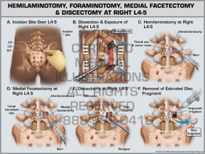 Exhibit of Hemilaminotomy, Foraminotomy, Medial Facetectomy & Discectomy at Right L4-5. Exhibit of Hemilaminotomy, Foraminotomy, Medial Facetectomy & Discectomy at Right L4-5.