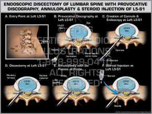 Exhibit of Endoscopic Discectomy of Lumbar Spine with Provocative Discography, Annuloplasty & Steroid Injection of L5-S1. Exhibit of Endoscopic Discectomy of Lumbar Spine with Provocative Discography, Annuloplasty & Steroid Injection of L5-S1.
