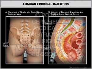 Exhibit of Lumbar Epidural Injection. Exhibit of Lumbar Epidural Injection.