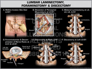 Exhibit of Lumbar Laminectomy, Foraminotomy & Discectomy. Exhibit of Lumbar Laminectomy, Foraminotomy & Discectomy.