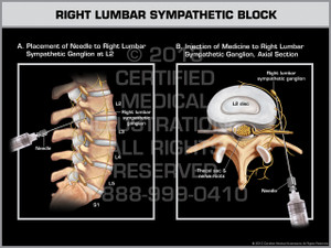 Exhibit of Right Lumbar Sympathetic Block. Exhibit of Right Lumbar Sympathetic Block.