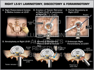 Exhibit of Right L5-S1 Laminotomy, Discectomy & Foraminotomy. Exhibit of Right L5-S1 Laminotomy, Discectomy & Foraminotomy.