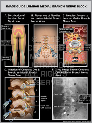 Exhibit of Image-Guide Lumbar Medial Branch Nerve Block Male. Exhibit of Image-Guide Lumbar Medial Branch Nerve Block Male.