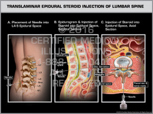 Exhibit of Translaminar Epidural Steroid Injection of Lumbar Spine Male.