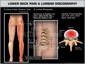Exhibit of Lower Back Pain & Lumbar Discography. Exhibit of Lower Back Pain & Lumbar Discography.