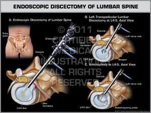 Exhibit of Endoscopic Discectomy of Lumbar Spine.