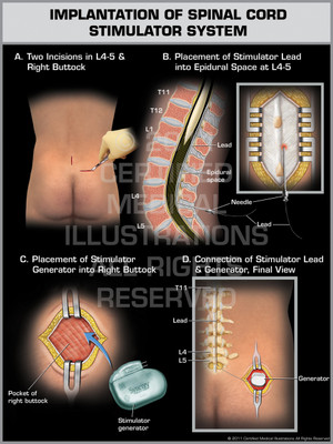Exhibit of Implantation of Spinal Cord Stimulator System. Exhibit of Implantation of Spinal Cord Stimulator System.