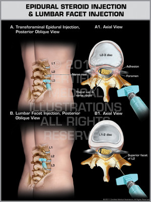 Exhibit of Epidural Steroid Injection & Lumbar Facet Injection.