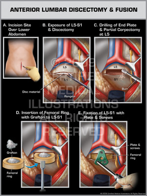 Exhibit of Anterior Lumbar Discectomy & Fusion Female. Exhibit of Anterior Lumbar Discectomy & Fusion Female.