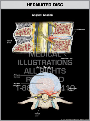 Exhibit of Herniated Disc. Exhibit of Herniated Disc.