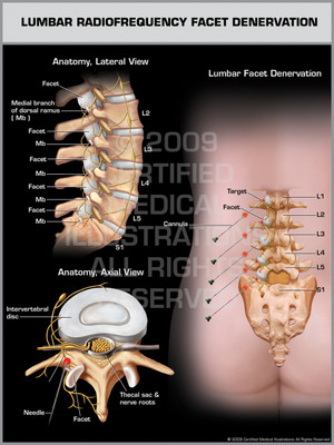 Exhibit of Lumbar Radiofrequency Facet Denervation.