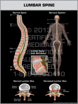 Exhibit of Lumbar Spine.