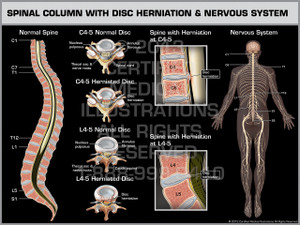 Exhibit of Spinal Column with Disc Herniation & Nervous System.