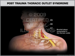 Exhibit of Post Trauma Thoracic Outlet Syndrome Male. Exhibit of Post Trauma Thoracic Outlet Syndrome Male.