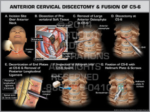 Exhibit of Anterior Cervical Discectomy & Fusion of C5-6 Female.