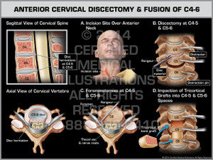 Exhibit of Anterior Cervical Discectomy & Fusion of C4-6. Exhibit of Anterior Cervical Discectomy & Fusion of C4-6.