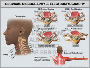 Exhibit of Cervical Discography & Electromyography.