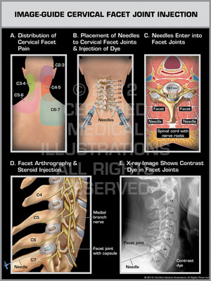 Exhibit of Image-Guide Cervical Facet Joint Injection Male. Exhibit of Image-Guide Cervical Facet Joint Injection Male.