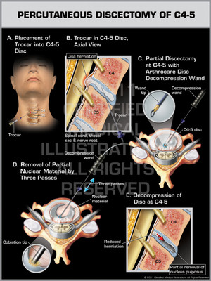 Exhibit of Percutaneous Discectomy of C4-5. Exhibit of Percutaneous Discectomy of C4-5.