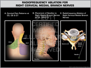 Exhibit of Radiofrequency Ablation for Right Cervical Medial Branch Nerves. Exhibit of Radiofrequency Ablation for Right Cervical Medial Branch Nerves.
