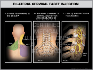 Exhibit of Bilateral Cervical Facet Injection. Exhibit of Bilateral Cervical Facet Injection.