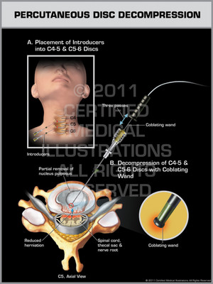Exhibit of Percutaneous Disc Decompression. Exhibit of Percutaneous Disc Decompression.