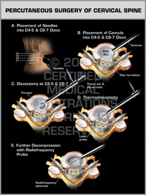 Exhibit of Percutaneous Surgery of Cervical Spine. Exhibit of Percutaneous Surgery of Cervical Spine.