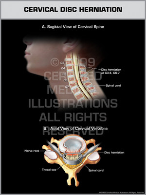 Exhibit of Cervical Disc Herniation.