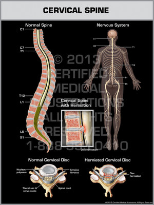 Exhibit of Cervical Spine. Exhibit of Cervical Spine.
