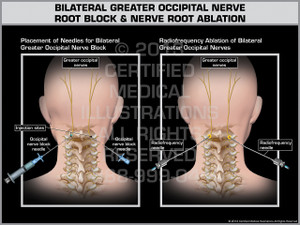 Exhibit of Bilateral Greater Occipital Nerve Root Block & Nerve Root Ablation. Exhibit of Bilateral Greater Occipital Nerve Root Block & Nerve Root Ablation.