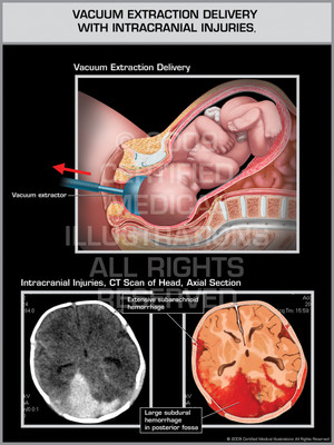 Exhibit of Vacuum Extraction Delivery with Intracranial Injuries. Exhibit of Vacuum Extraction Delivery with Intracranial Injuries.