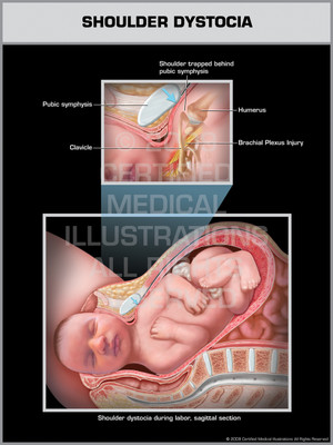 Exhibit of Shoulder Dystocia. Exhibit of Shoulder Dystocia.