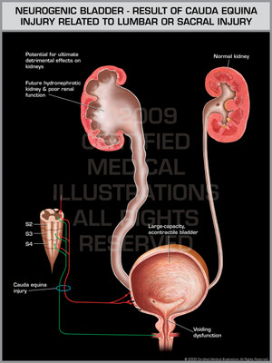 Neurogenic Bladder - Result of Cauda Equina Injury Related to Lumbar or Sacral Injury Neurogenic Bladder - Result of Cauda Equina Injury Related to Lumbar or Sacral Injury