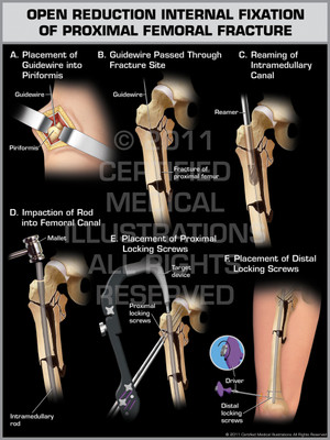 Exhibit of Open Reduction Internal Fixation of Proximal Femoral Fracture. Exhibit of Open Reduction Internal Fixation of Proximal Femoral Fracture.