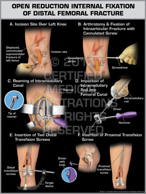 Exhibit of Open Reduction Internal Fixation of Distal Femoral Fracture. Exhibit of Open Reduction Internal Fixation of Distal Femoral Fracture.